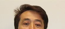 Eyelid Surgery After Photo by James Lee, MD; Laval, QC - Case 35564