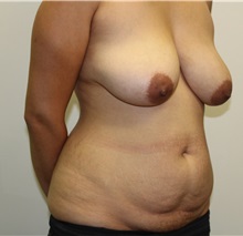 Liposuction Before Photo by James Lee, MD; Laval, QC - Case 35569