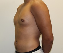 Male Breast Reduction After Photo by James Lee, MD; Laval, QC - Case 35571