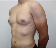 Male Breast Reduction Before Photo by James Lee, MD; Laval, QC - Case 35571