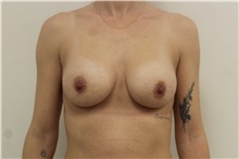 Breast Augmentation After Photo by James Lee, MD; Laval, QC - Case 51288
