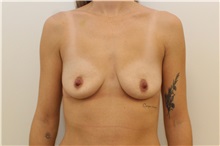 Breast Augmentation Before Photo by James Lee, MD; Laval, QC - Case 51288