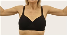 Arm Lift After Photo by James Lee, MD; Laval, QC - Case 51287