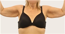 Arm Lift Before Photo by James Lee, MD; Laval, QC - Case 51287