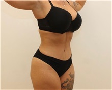 Tummy Tuck After Photo by James Lee, MD; Laval, QC - Case 51285