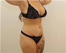 Tummy Tuck Before Photo by James Lee, MD; Laval, QC - Case 51285