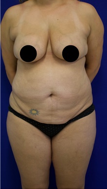 Tummy Tuck Before Photo by Munique Maia, MD; Tysons Corner, VA - Case 47336