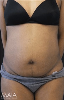 Tummy Tuck Before Photo by Munique Maia, MD; Tysons Corner, VA - Case 47352