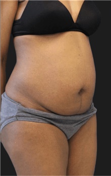 Tummy Tuck Before Photo by Munique Maia, MD; Tysons Corner, VA - Case 47352