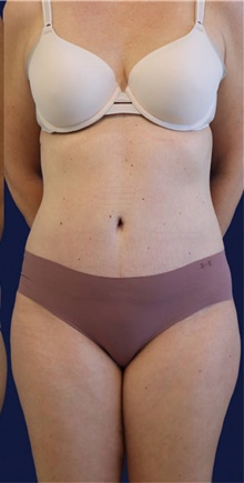 Tummy Tuck After Photo by Munique Maia, MD; Tysons Corner, VA - Case 47353