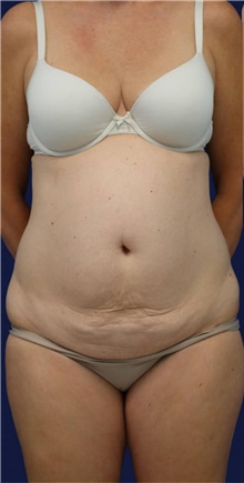 Tummy Tuck Before Photo by Munique Maia, MD; Tysons Corner, VA - Case 47353