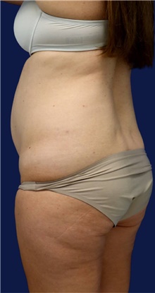 Tummy Tuck Before Photo by Munique Maia, MD; Tysons Corner, VA - Case 47353