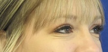 Eyelid Surgery After Photo by Munique Maia, MD; Tysons Corner, VA - Case 47358