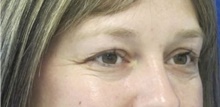 Eyelid Surgery Before Photo by Munique Maia, MD; Tysons Corner, VA - Case 47358