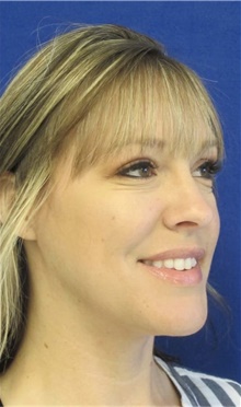 Liposuction After Photo by Munique Maia, MD; Tysons Corner, VA - Case 47360