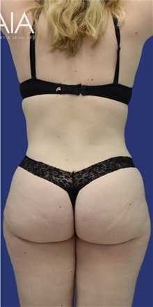Liposuction After Photo by Munique Maia, MD; Tysons Corner, VA - Case 47361