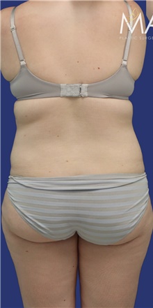 Liposuction Before Photo by Munique Maia, MD; Tysons Corner, VA - Case 47361