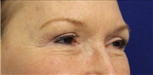Eyelid Surgery After Photo by Munique Maia, MD; Tysons Corner, VA - Case 47362