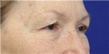 Eyelid Surgery Before Photo by Munique Maia, MD; Tysons Corner, VA - Case 47362