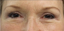 Eyelid Surgery After Photo by Munique Maia, MD; Tysons Corner, VA - Case 47362