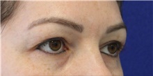 Eyelid Surgery Before Photo by Munique Maia, MD; Tysons Corner, VA - Case 47363