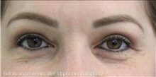 Eyelid Surgery After Photo by Munique Maia, MD; Tysons Corner, VA - Case 47363
