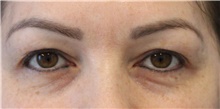 Eyelid Surgery Before Photo by Munique Maia, MD; Tysons Corner, VA - Case 47363