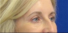 Eyelid Surgery After Photo by Munique Maia, MD; Tysons Corner, VA - Case 47364