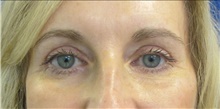 Eyelid Surgery After Photo by Munique Maia, MD; Tysons Corner, VA - Case 47364