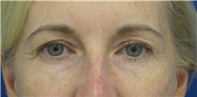 Eyelid Surgery Before Photo by Munique Maia, MD; Tysons Corner, VA - Case 47364