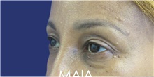 Eyelid Surgery Before Photo by Munique Maia, MD; Tysons Corner, VA - Case 47369
