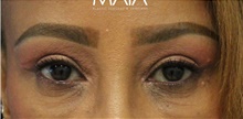 Eyelid Surgery After Photo by Munique Maia, MD; Tysons Corner, VA - Case 47369