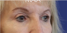 Eyelid Surgery After Photo by Munique Maia, MD; Tysons Corner, VA - Case 47370