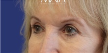 Eyelid Surgery After Photo by Munique Maia, MD; Tysons Corner, VA - Case 47370