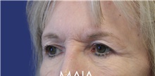 Eyelid Surgery Before Photo by Munique Maia, MD; Tysons Corner, VA - Case 47370