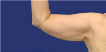 Arm Lift Before Photo by Munique Maia, MD; Tysons Corner, VA - Case 47375