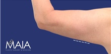 Arm Lift After Photo by Munique Maia, MD; Tysons Corner, VA - Case 47375