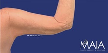 Arm Lift After Photo by Munique Maia, MD; Tysons Corner, VA - Case 47376