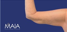 Arm Lift After Photo by Munique Maia, MD; Tysons Corner, VA - Case 47376
