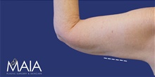 Arm Lift After Photo by Munique Maia, MD; Tysons Corner, VA - Case 47377