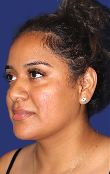 Liposuction After Photo by Munique Maia, MD; Tysons Corner, VA - Case 47378