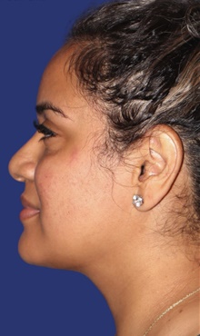 Liposuction After Photo by Munique Maia, MD; Tysons Corner, VA - Case 47378