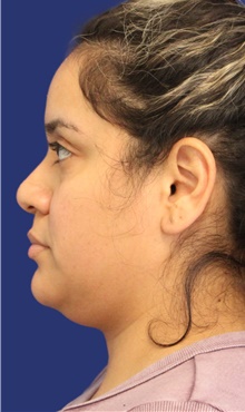 Liposuction Before Photo by Munique Maia, MD; Tysons Corner, VA - Case 47378