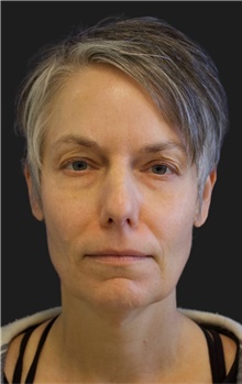 Facelift Before Photo by Munique Maia, MD; Tysons Corner, VA - Case 48683
