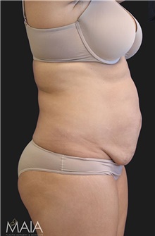 Tummy Tuck Before Photo by Munique Maia, MD; Tysons Corner, VA - Case 48688