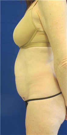 Tummy Tuck Before Photo by Munique Maia, MD; Tysons Corner, VA - Case 48689