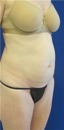 Tummy Tuck Before Photo by Munique Maia, MD; Tysons Corner, VA - Case 48689