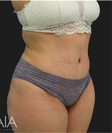 Tummy Tuck After Photo by Munique Maia, MD; Tysons Corner, VA - Case 48690
