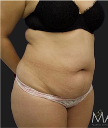Tummy Tuck Before Photo by Munique Maia, MD; Tysons Corner, VA - Case 48690