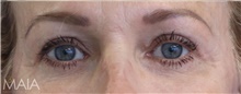 Eyelid Surgery After Photo by Munique Maia, MD; Tysons Corner, VA - Case 48693